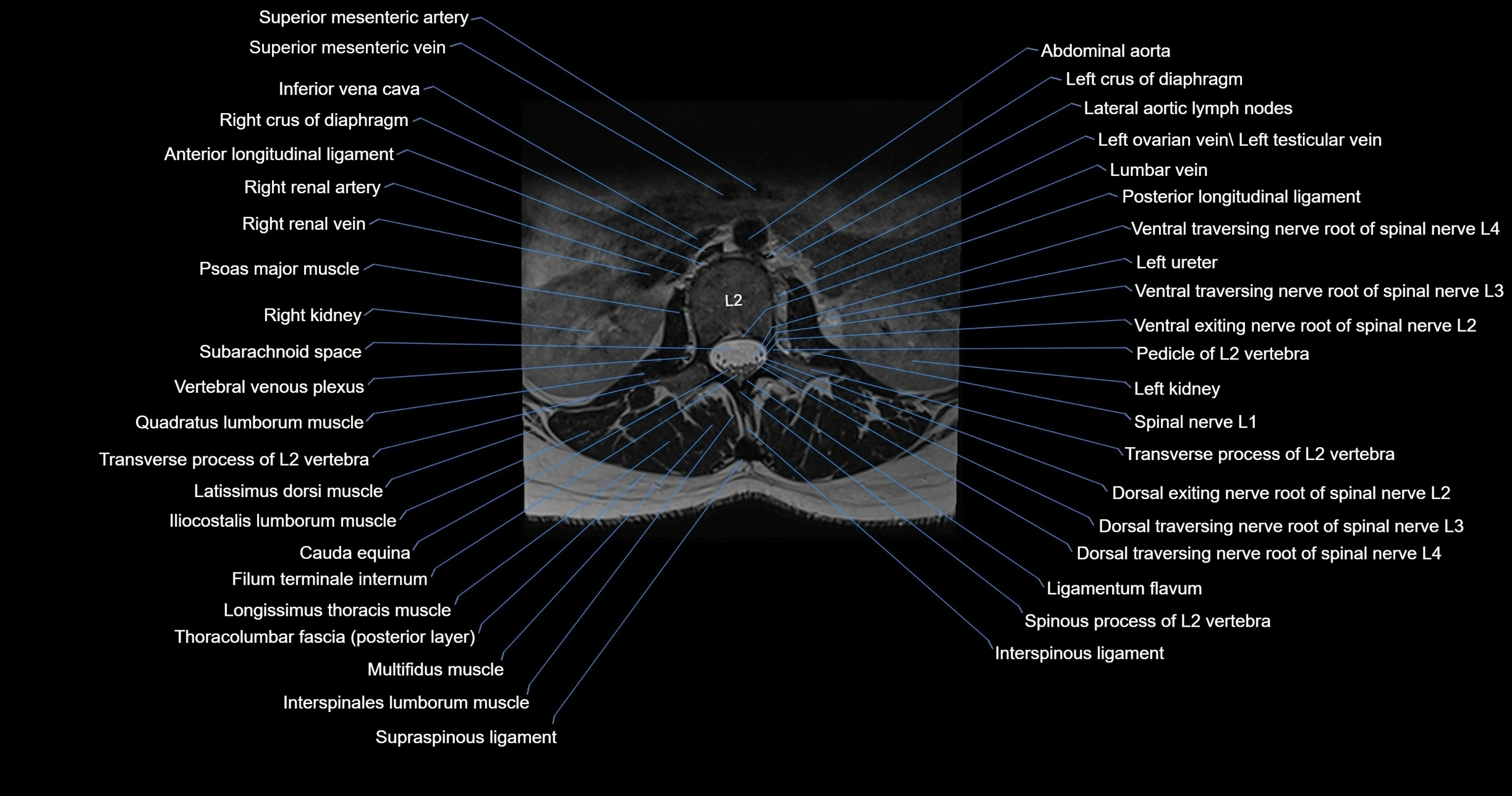 MRI lumbar spine axial cross sectional anatomy 3T radiology  image-img-00001-00015.webp